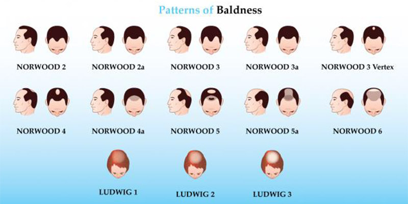 pattern-of-baldness